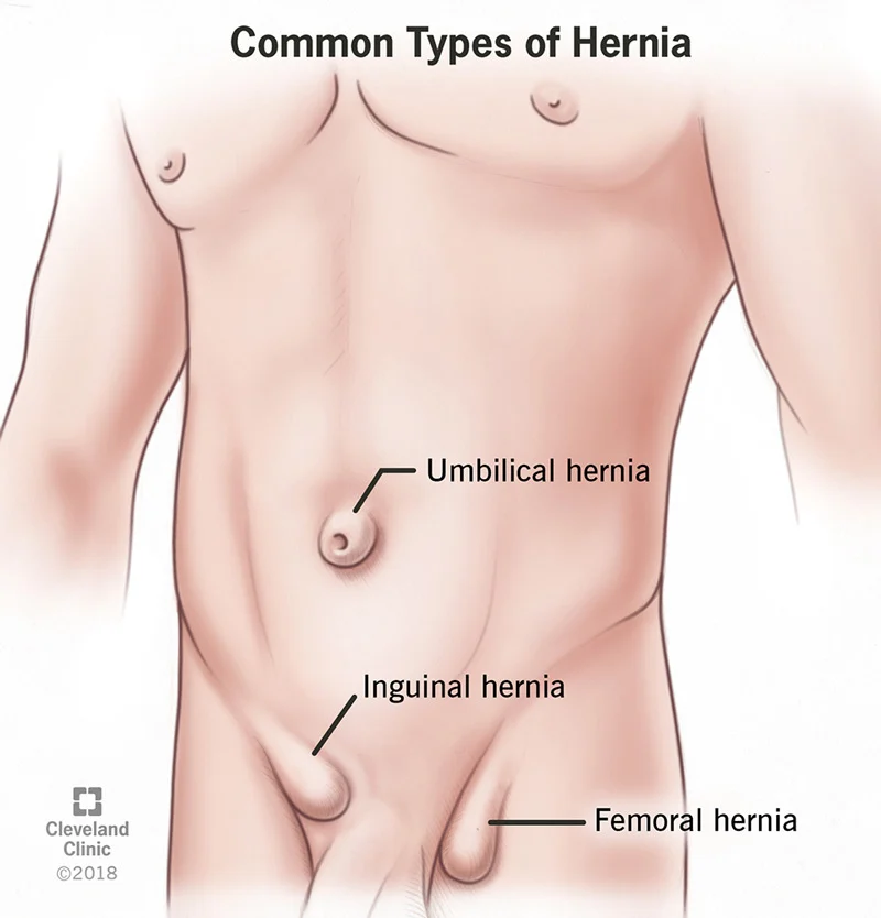 Hernia medical