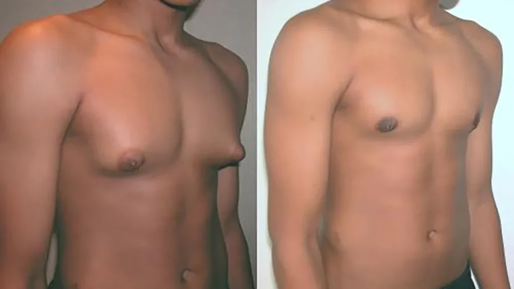 Gynecomastia medical