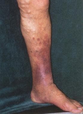 Varicose Veins Medical