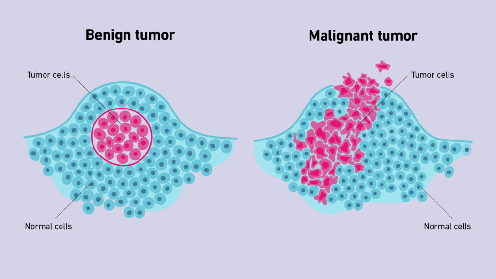 Tumor growth medical
