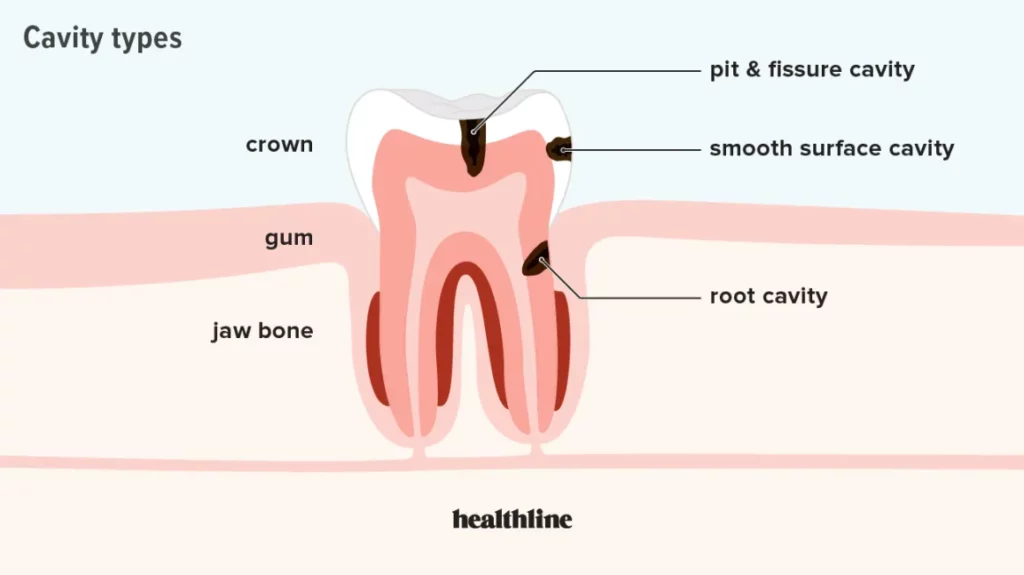 cavity