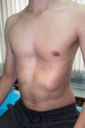 deformity of chest wall 