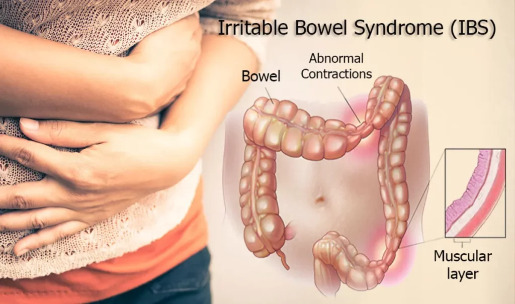 Irritable bowel syndrome medical