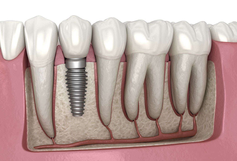 teeth implantation