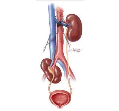 ectopic kidney medical
