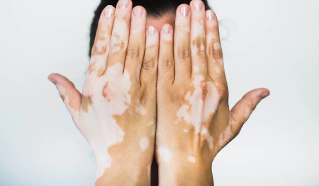 Vitiligo skin