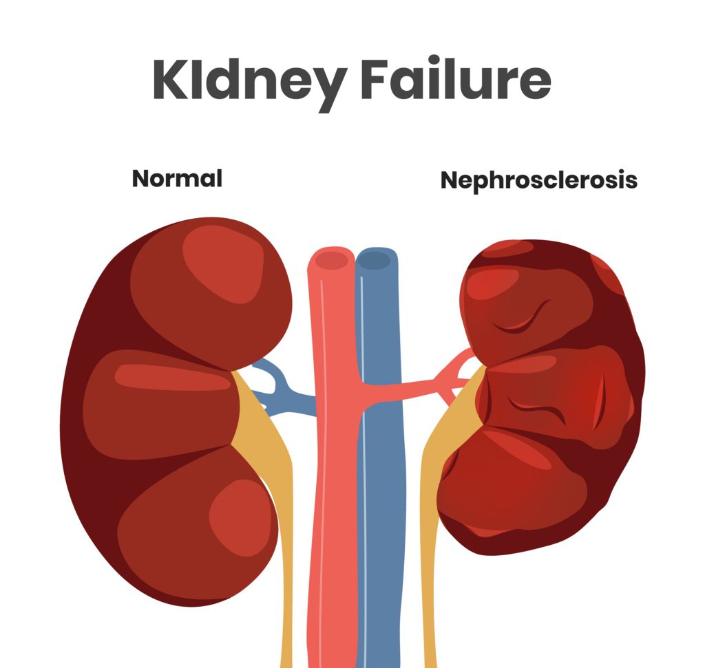 kidney failure