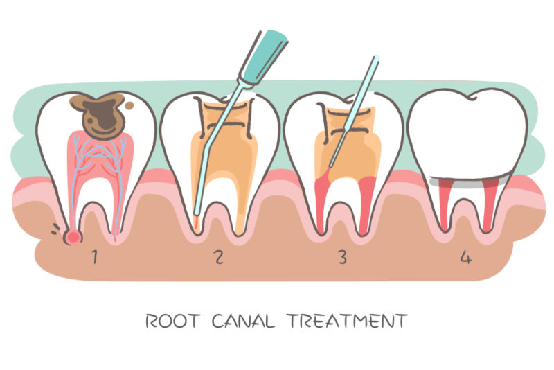 root canal treatment teeth