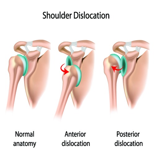 medicals of Shoulder Dislocation