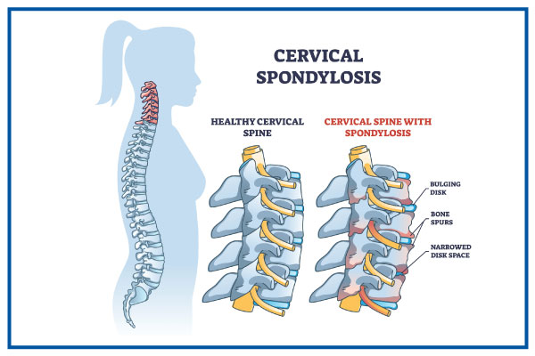 Cervical spondylosis medical