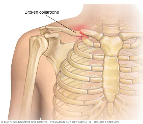 CLAVICLE BONE FRACTURE