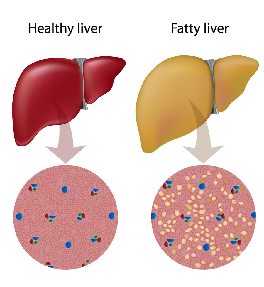  fatty liver