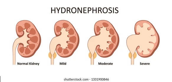 Hydronephrosis medical