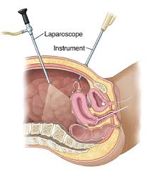 Laparoscopy/ Keyhole Surgery medical