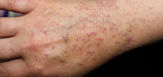 Lichen Planus skin