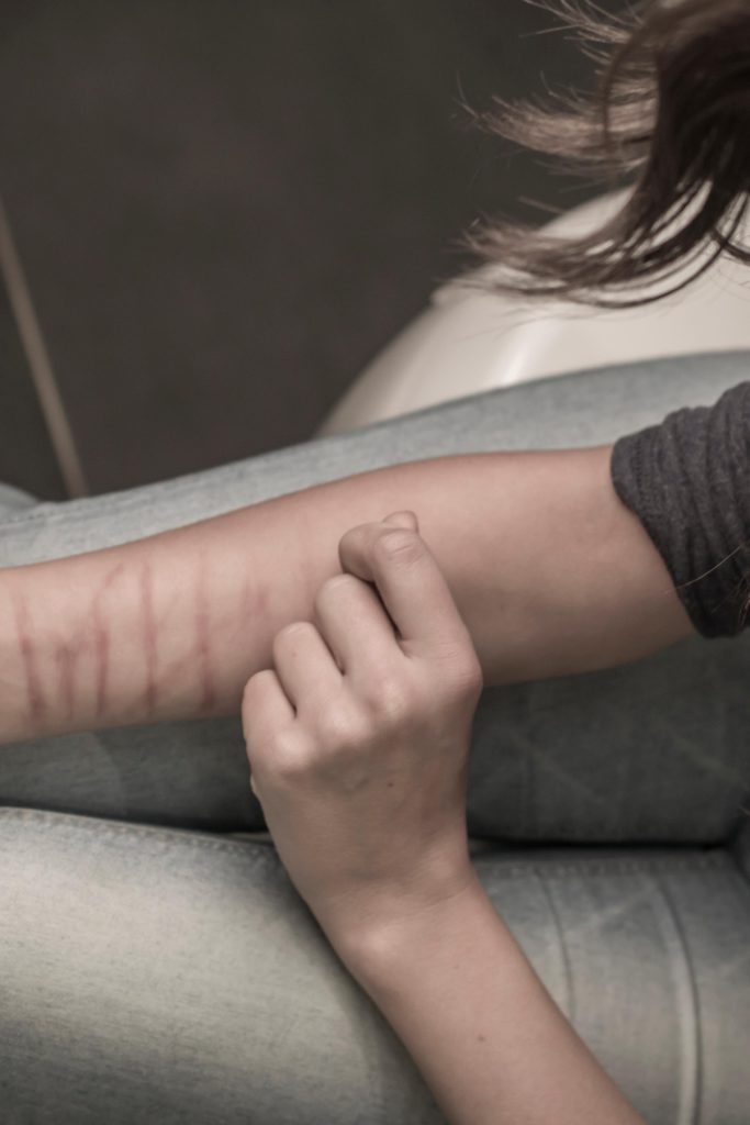 self-harm scars
