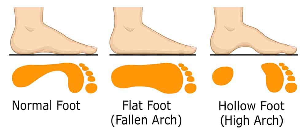 flat foot medical merchant navy