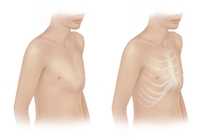 Pectus carinatum medical merchant navy