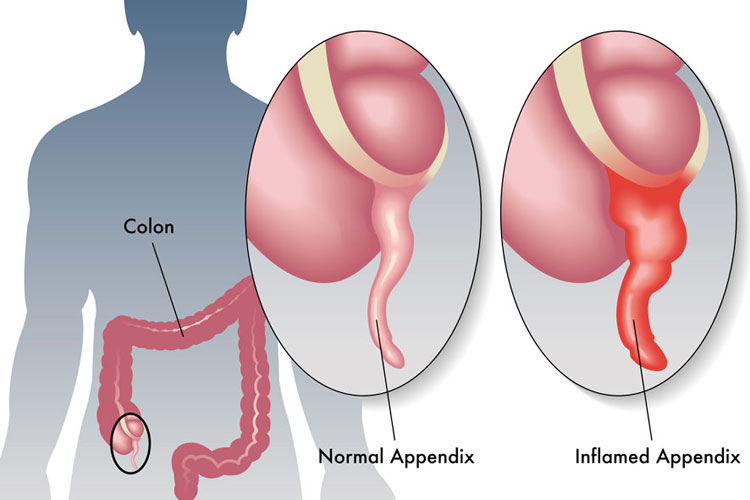 appendicitis surgery merchant navy