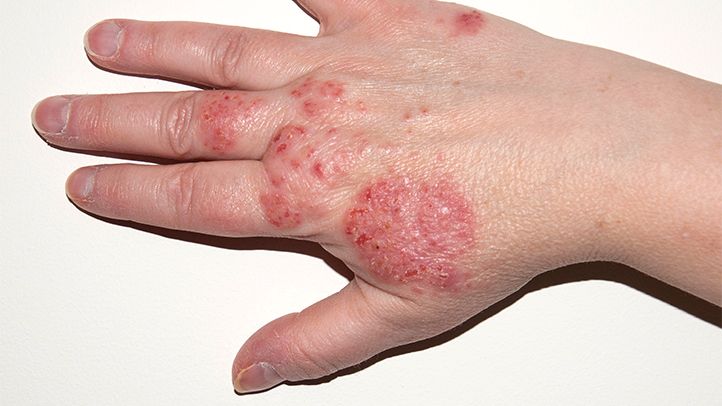 eczema