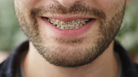 braces