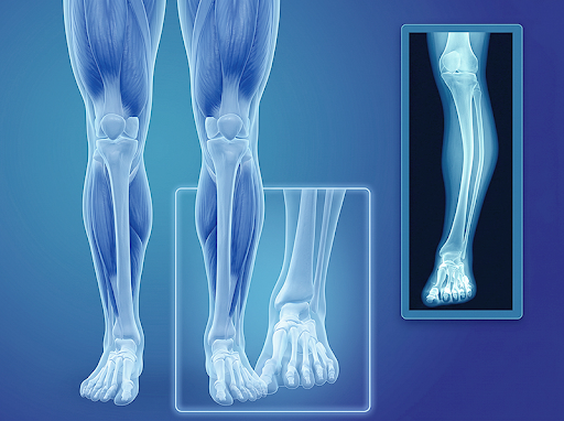 Bone, Fracture and Deformity Condition