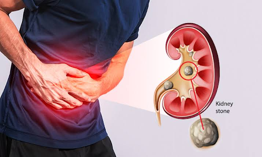 Kidney and Stones